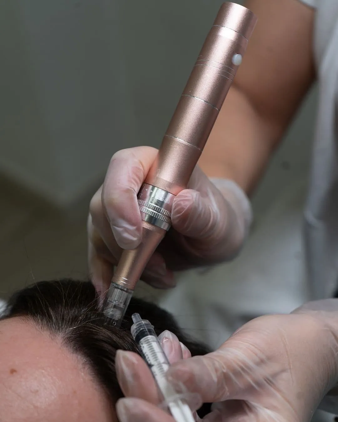 Comprehensive Hair Loss Treatment in Kharadi Pune