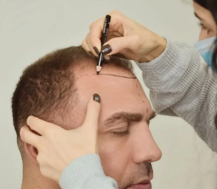 Hair Transplant