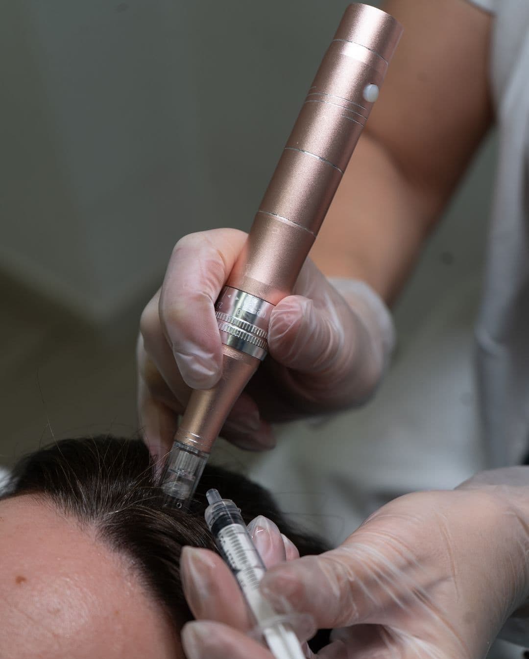 Understanding PRP for Hair