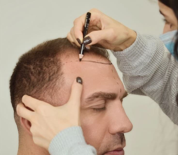 Hair Transplant
