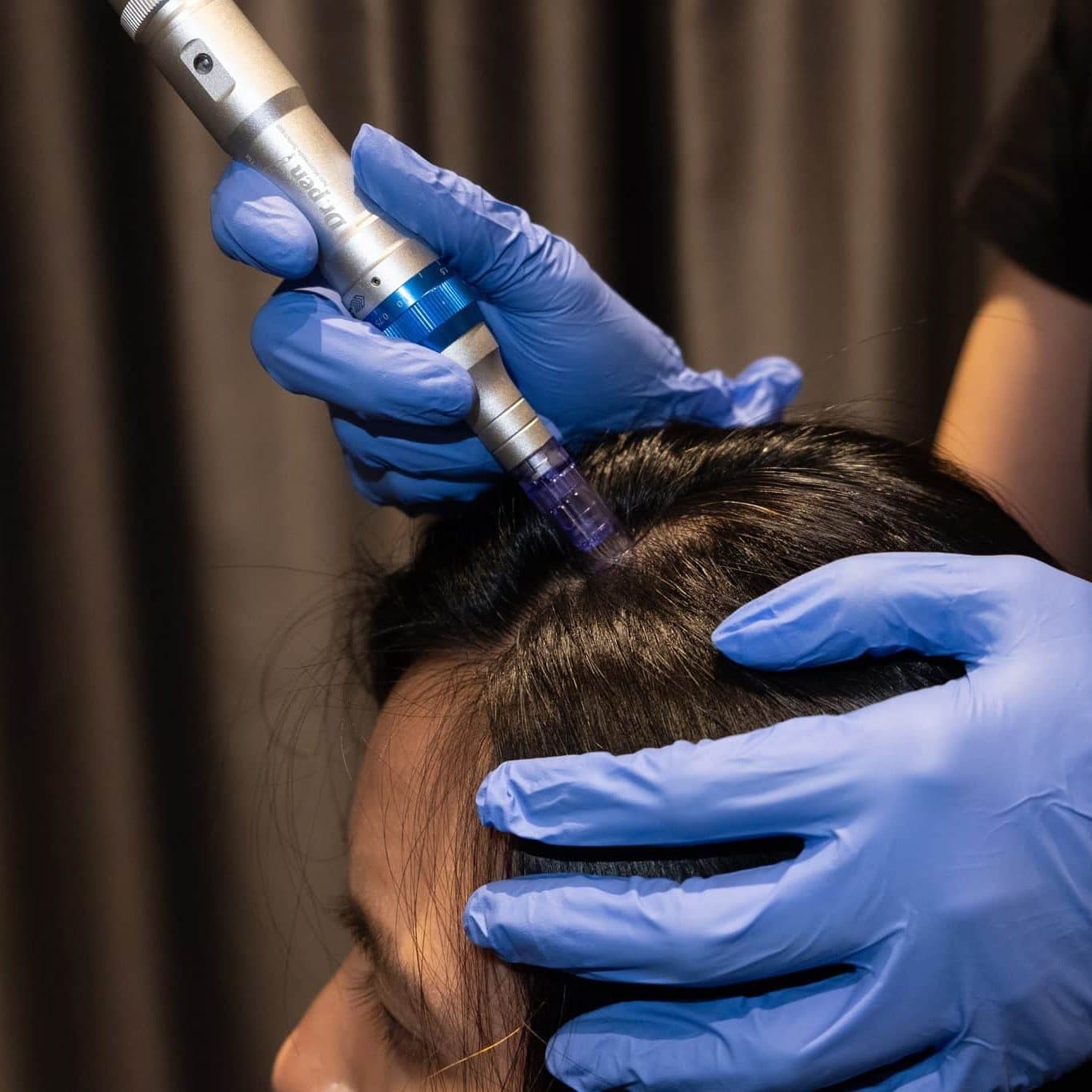 Hair Microneedling