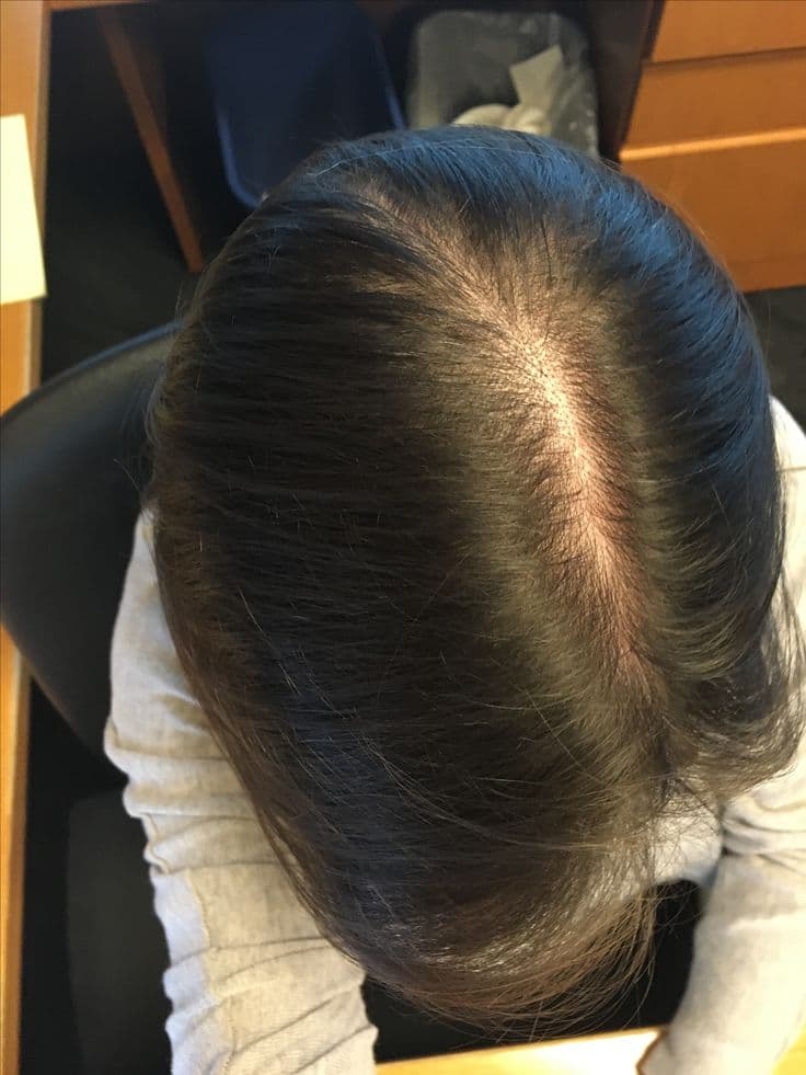 After Hair Transplant