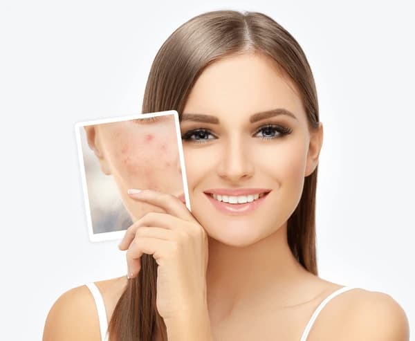 Skin resurfacing