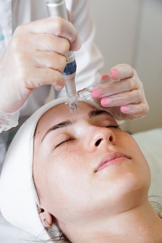 Face Microneedling