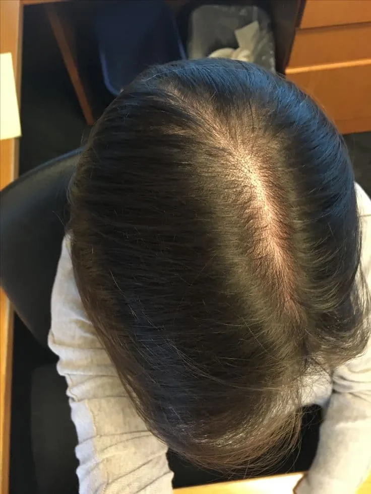 After hairline hair transplant 10 months Healthfusion Kharadi