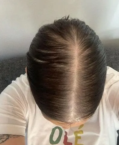 Before hairline hair transplant FUE Healthfusion Pune