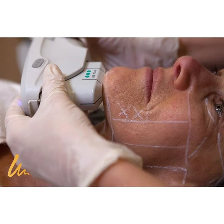 Face Fat Reduction