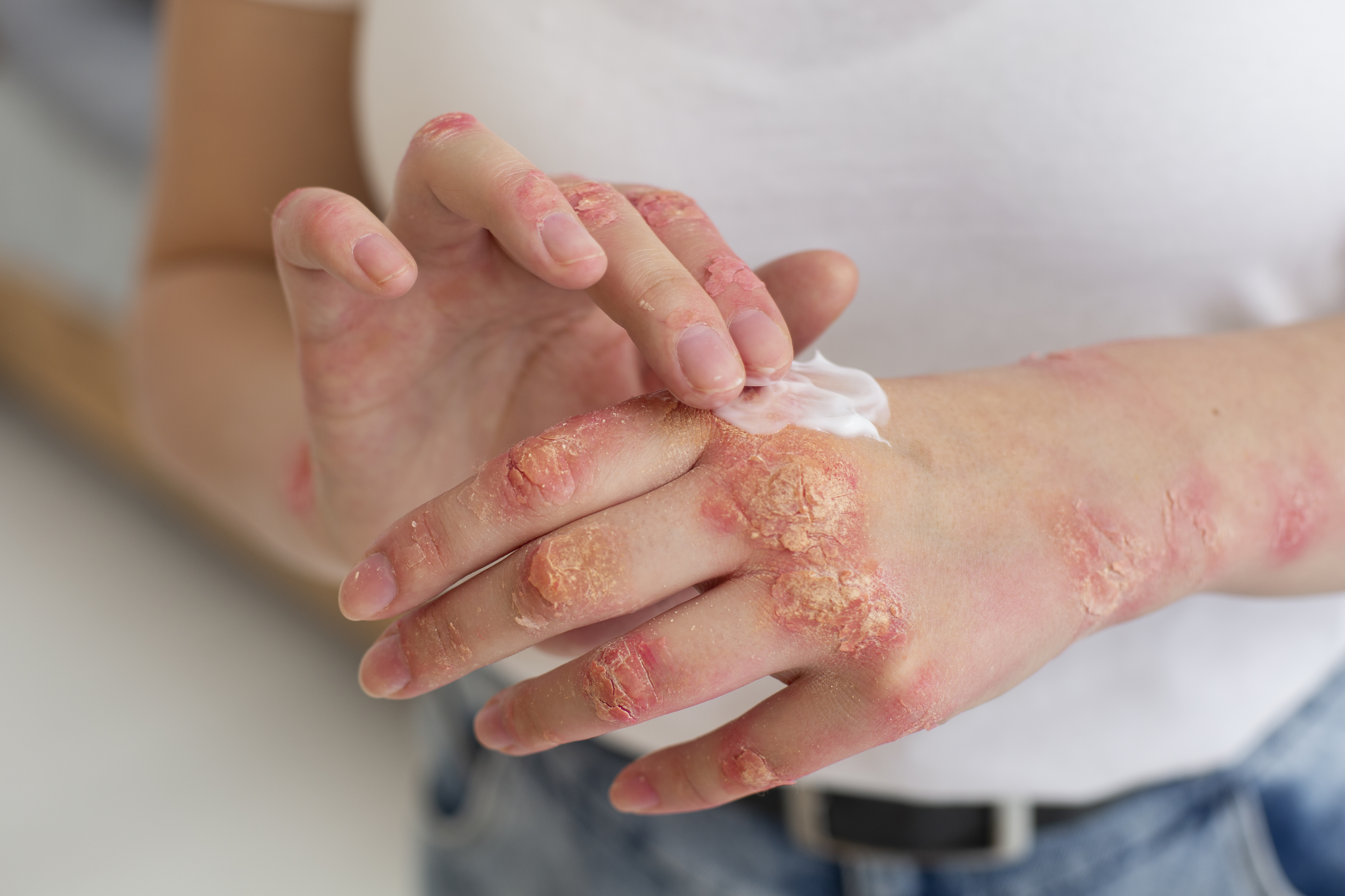 Atopic Dermatitis