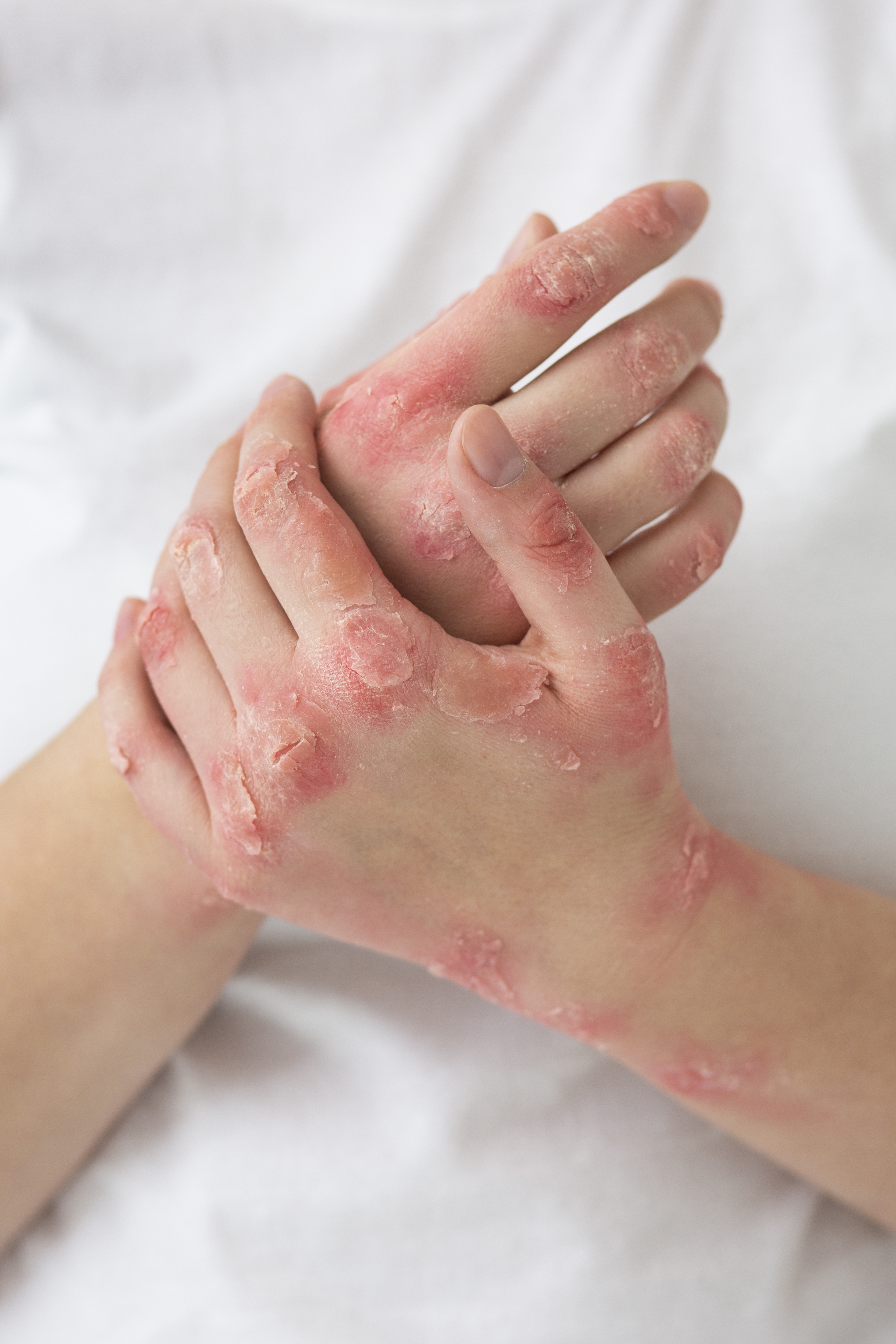 Dyshidrotic Eczema